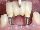 Removable Prosthetics Implant-Retained Denture: Brevis attachments provide snap-on retention with abutments for soft tissue borne removable dentures.