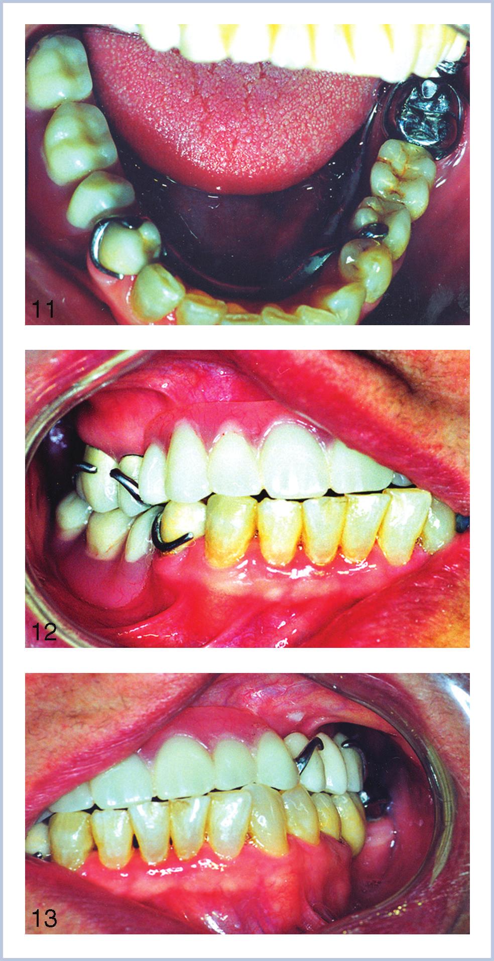 Firas A. M. AL Quran et al ed incidence of this complication varies in the literature. Dental implants are government regulated devices in the United States.