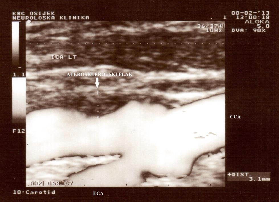 Slika 4.3. Ultrazvučni prikaz aterosklerotskog plaka proksimalnog segmenta unutarnje karotidne arterije najveće izmjerene debljine 3,1 mm (prikaz osnaženim doplerom, engl. power doppler) 2.