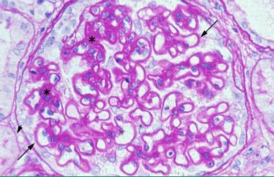 Nephro#c syndrome: Diagnosis categorized by glomerular lesion Membranous GN (30-35%)