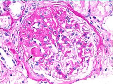 penicillamine, gold, captopril, NSAID Hepa##s B Malignancy (solid tumor, CLL) Focal