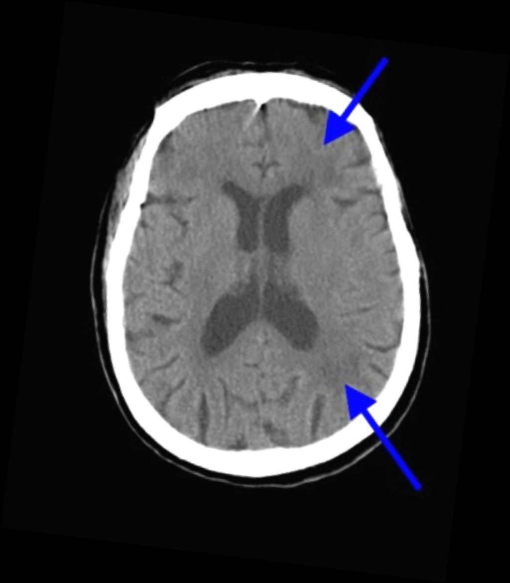 Anterior cerebral artery area