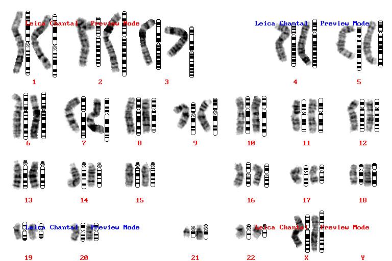 Karyotype The first technique for studying chromosomal abnormalities Diagnostic yield: 9%