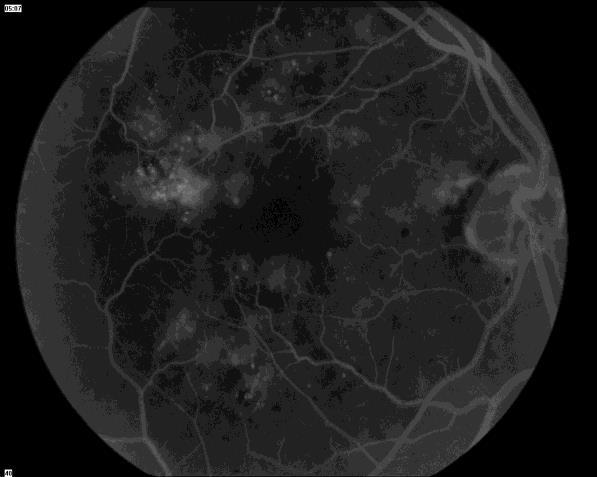When your retina doesn t get enough oxygen this will add insult to injury, exacerbating existing underlying