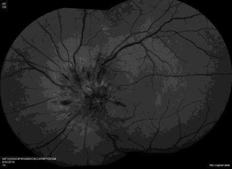Central Serous Retinopathy 36 year old