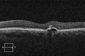 retinopathy Following a diagnosis of