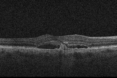 . 72 year old white female presents with sudden vision loss of the right eye (2015). She was treated with AVASTIN in 2011 for AMD.