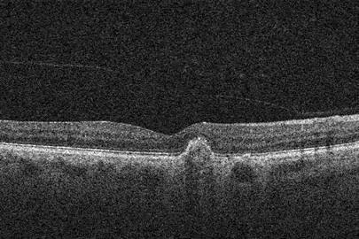 ? Choroidal thickness RPE layer and Bruchs membrane I diagnosed her with CSR and discussed the stimulants of CSR including.