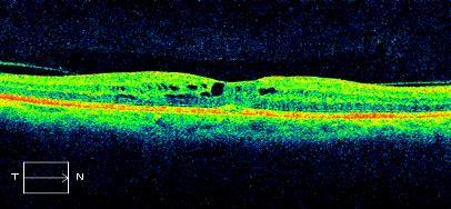 Ocular Coherence Tomography: February 2011 Some reduction in macular edema OU. NOW WHAT??? Mr.