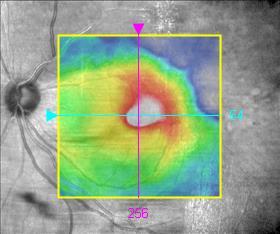 setting 63 year old woman with a retinal vein occlusion is treated with serial Avastin injections HMMM.