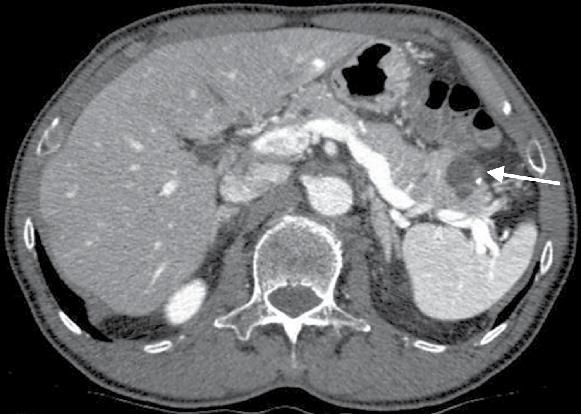 As prt of the clinicl work up, the ptient underwent CT scn (with nd without contrst medium) of the domen demonstrting loulted, exophytic cystic lesion in the til of the pncres.