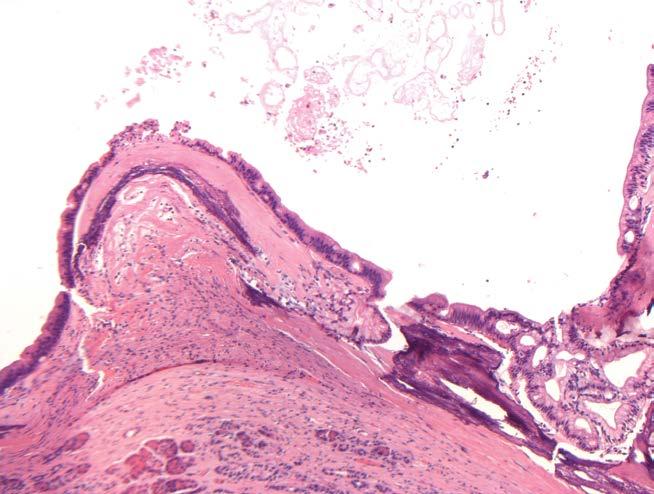 Figure 4. (). The cyst wll nd microscopiclly noted septum showed mnly osseous metplsi nd some clcifiction. (). The osseous metplsi ws immeditely eneth the lining epithelium nd foclly protruded into the cyst lumen.