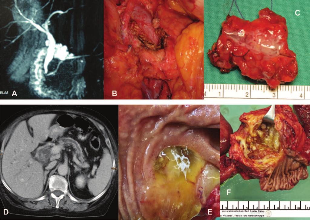 1304 Biology, Diagnosis, and Treatment of IPMN Figure 5. Clinical examples of IPMN. (A C): BD-IPMN. (A): MRCP; (B): Intraoperative situs after enucleation; (C): Surgical specimen with BD-IPMN.