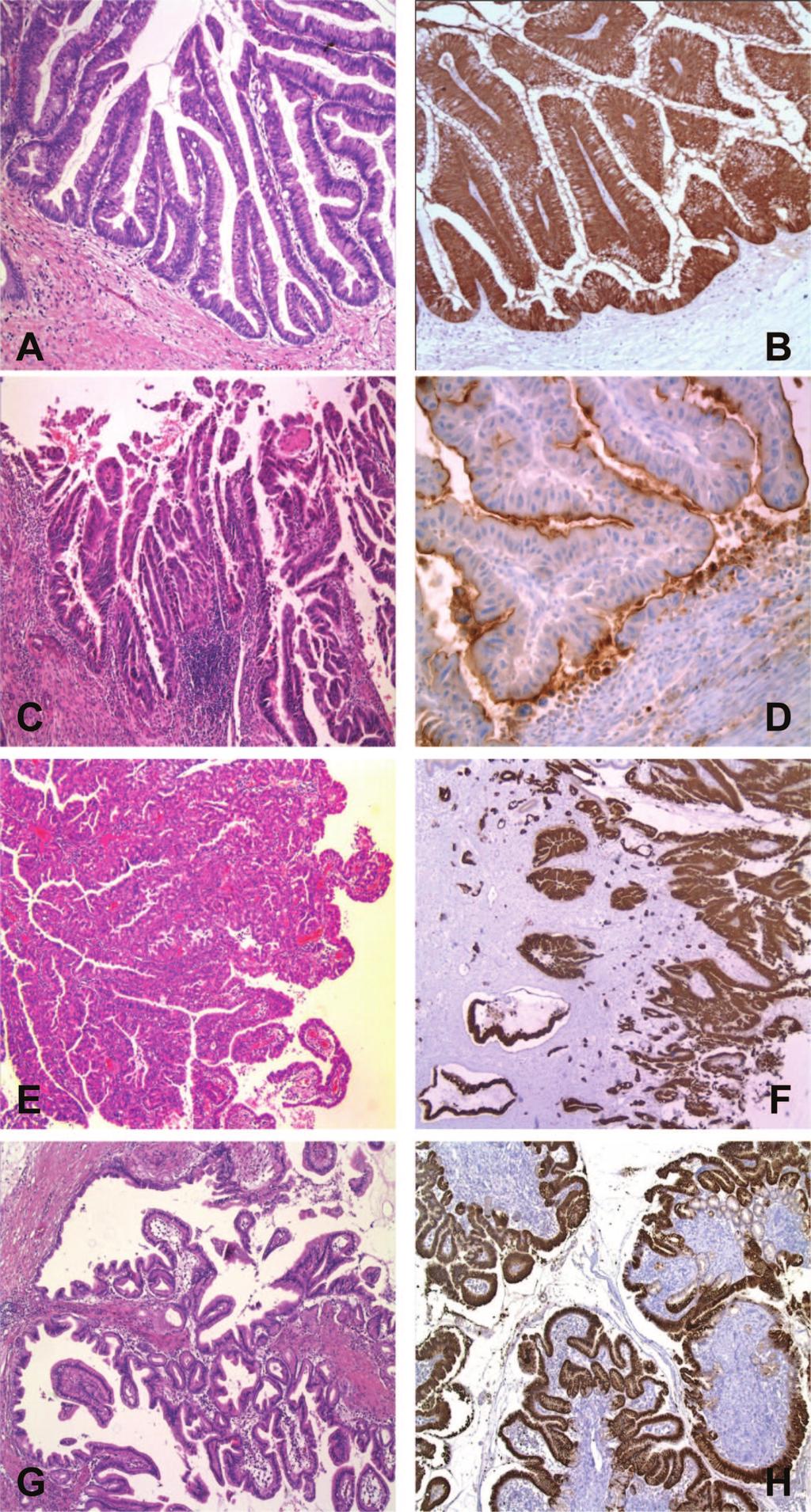 Gru tzmann, Niedergethmann, Pilarsky et al. 1297 Figure 2. Histopathological subtypes of intraductal papillary mucinous neoplasm (IPMN) of the pancreas and their typical mucin patterns.