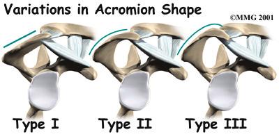 If any other condition decreases the amount of space between the acromion and the rotator cuff tendons, the impingement may get worse.