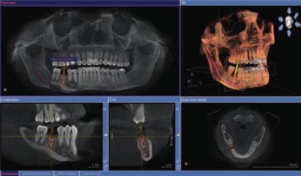 Thanks to the colored visualization of the nerve canal and the depiction of the bones in all dimensions, you can adapt the implant in an ideal manner to fit the patient s