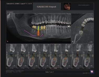 For beginners and specialists.    Safe implementation. Easily obtain Sirona SICAT* drilling templates by sending the planning data, the scan guide and a model to SICAT*.