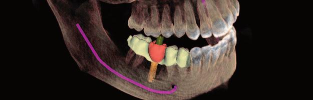 Sirona unites 3D imaging and CAD/CAM. Integrated Implantology with CEREC reduces the number of sessions necessary for the comlete implant process, saving you and your patient time and money.