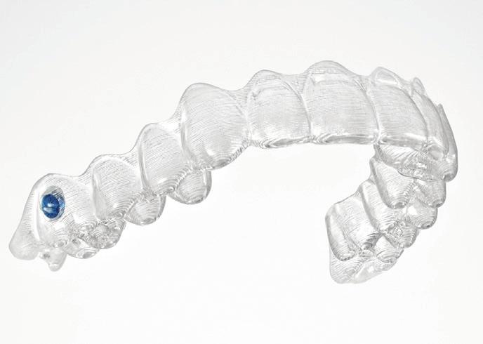 Class II Correction with Clear Aligner Systems. The Motion Appliance may be used with patients who want to be treated with clear aligners, but display a Class II malocclusion.