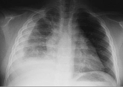 Type of injury Large pulmonary