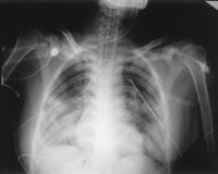 BLAST LUNG Over-pressurization wave Most common fatal injury Can be found 48 hours later Triad: