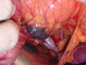 Image 8. Metastasis in the pancreas II.