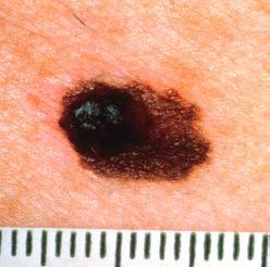 Melanoma can appear suddenly as a new mole, or it can develop slowly in or near an
