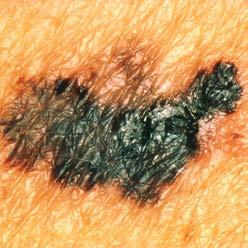 Almost everyone has moles, and the vast majority of them are perfectly harmless.