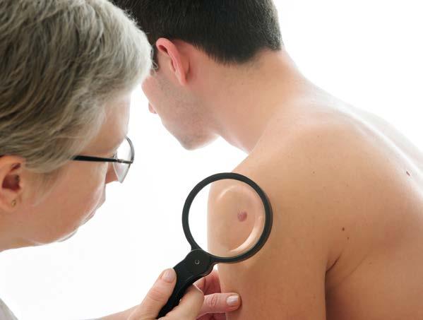 It is often linked to certain types of moles.