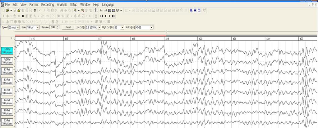 Electroencephalography (EEG) Pyramidal Neurons: Create an