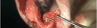 During initial lip closure, the floor of the nose is reconstructed. A very small deformity (malposition) of the nasal sill (0.