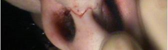 The incisions used to open the nose vary, but a combination of bilateral marginal incisions with an inverted-v mid-columellar incision is typically used [22].