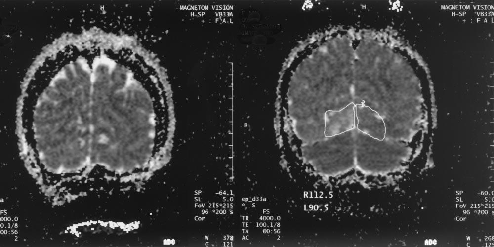 1688 PILLAI AJNR: 23, November/December 2002 FIG 3. ADC maps (4000/100/2) from case 2 (left) and case 1 (right).