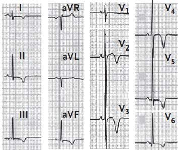 ABNORMAL ECG IN ATHLETES LONGITUDINAL CASE-CONTROL STUDY 12,550 Italian athletes 81 identified with diffuse,