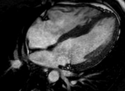 Cardiac MRI: 9/2008 4 Chamber Inferior