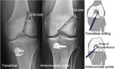 Transtibial vs AM portal tech in single bundle ACL Wang et al, 2013 Outcomes of knee kinematics during