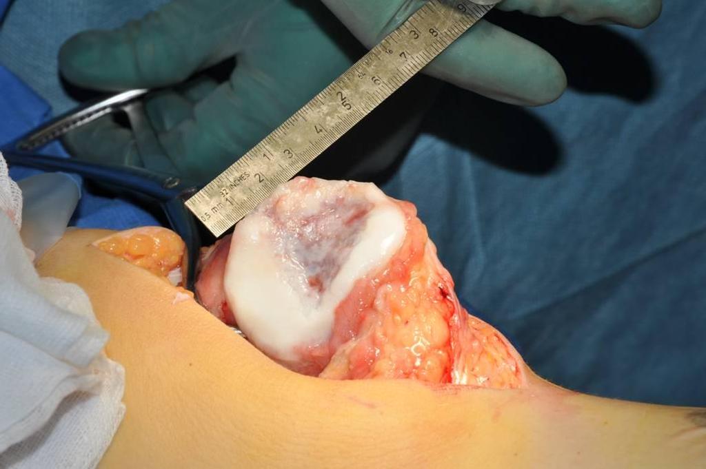 Injury to articular cartilage of the knee Meniscus injury (13 %) OCD