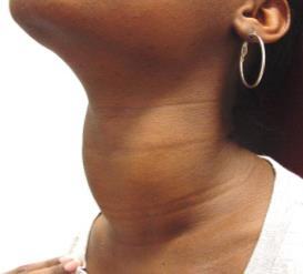 have a slightly enlarged thyroid gland (goiter) Causes eyes to protrude (exophthalmos) Graves Disease