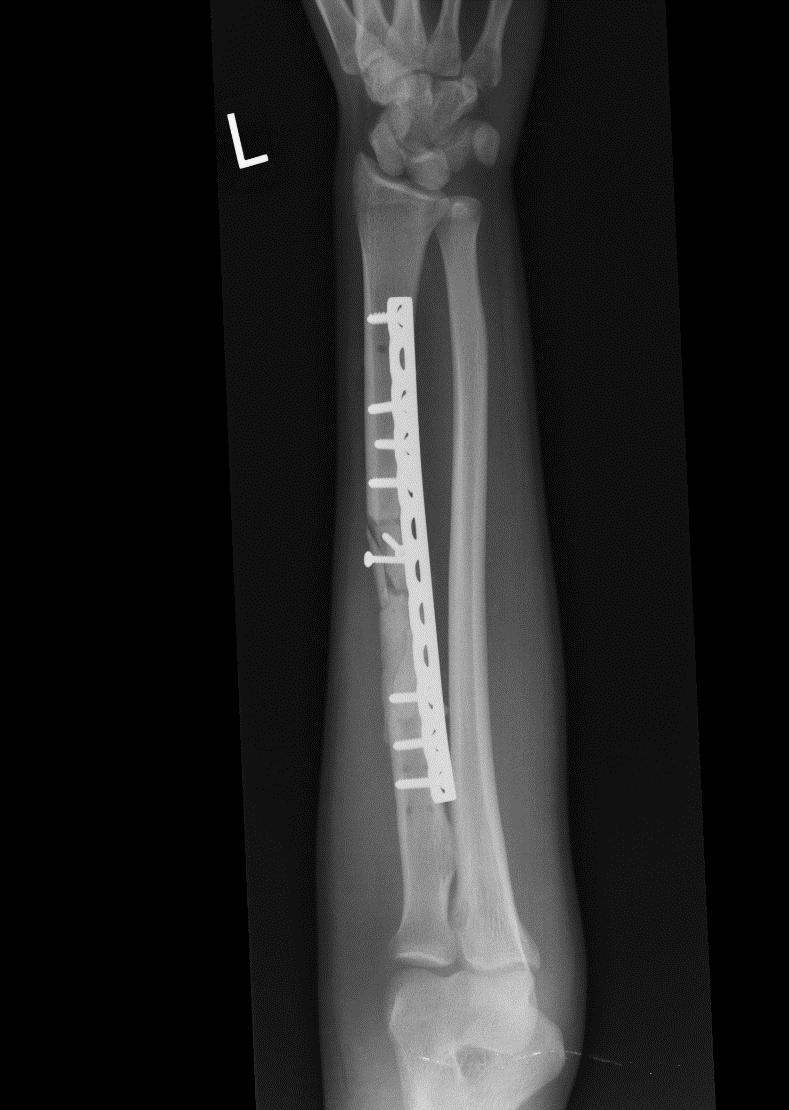 Case 9: Radial Shaft Bone Defect Post-op radiograph following