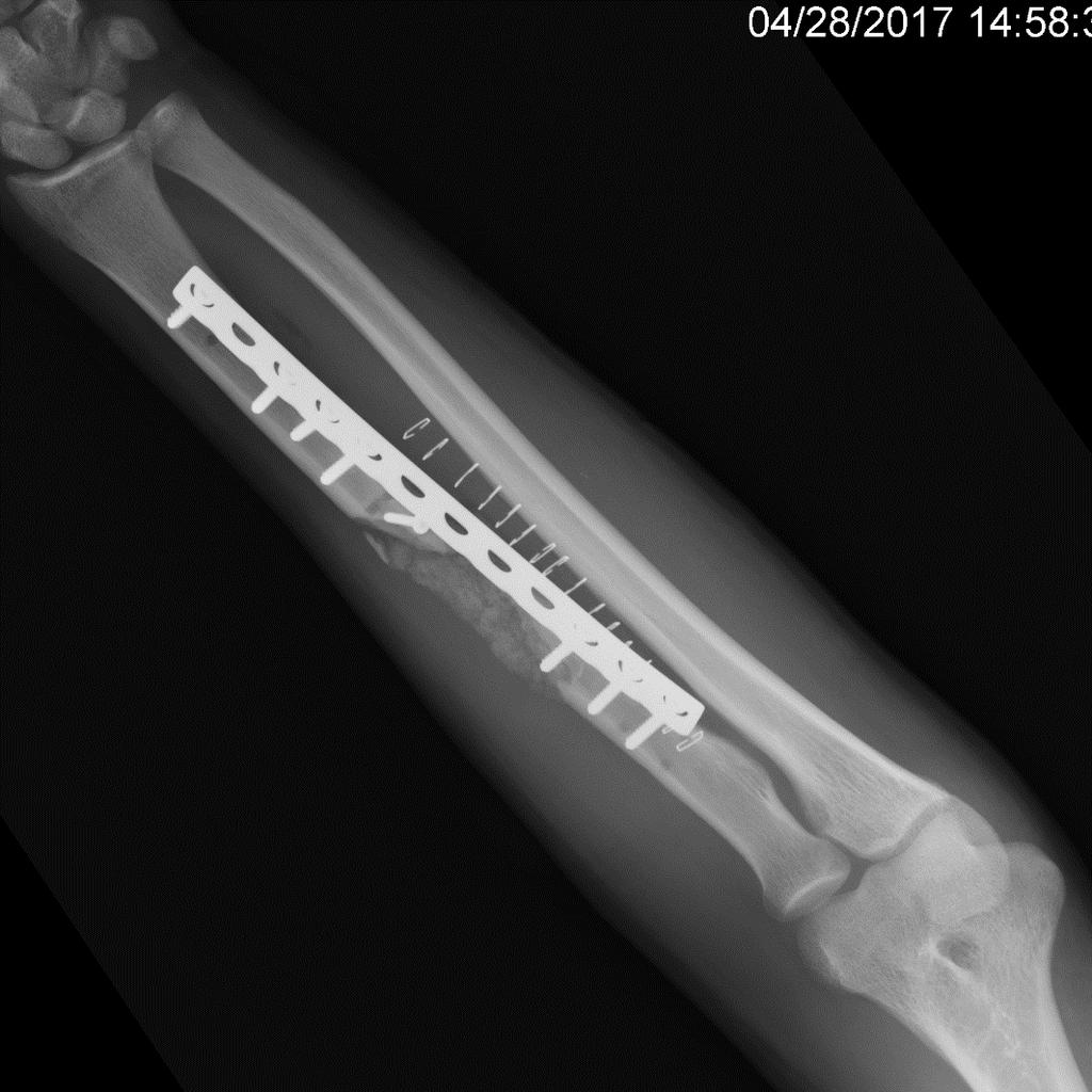 Case 9: Radial Shaft Bone Defect Immediate