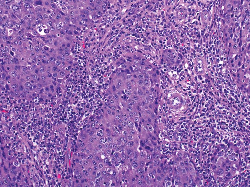 HER2+ Carcinoma with brisk