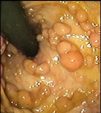 Parathyroid Pituitary Pancreatic Islet Cell Gastrinoma Insulinoma Glucagonoma MEN1 (menin) gene Autosomal dominant 23