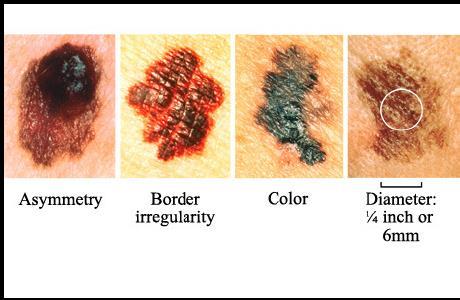Familial Melanoma (FM) Syndrome Characterized by a dominant pattern of melanoma and dysplastic nevi Risk