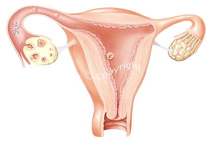 Lynch Syndrome Early but variable age at colorectal and endometrial cancer diagnosis