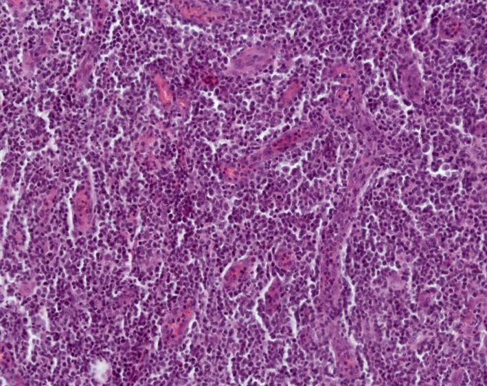 Angioimmunoblastic T cell lymphoma CD3