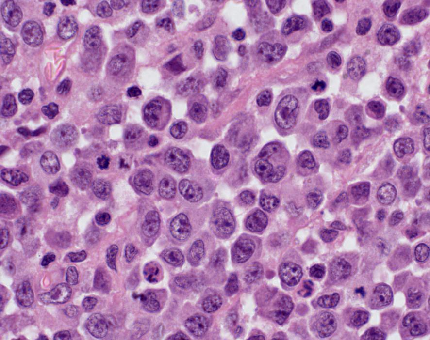 Anaplastic Large Cell Lymphoma, ALK-positive