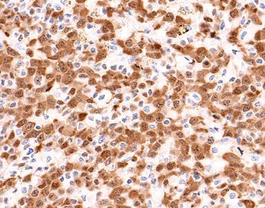Anaplastic Large Cell Lymphoma,