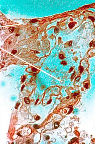 Lung Gaucher Cells Interstitial macrophages Alveolar macrophages Significant lung involvement, shown here, is