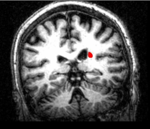 Stroke is heterogeneous in that the location and size of the lesion varies