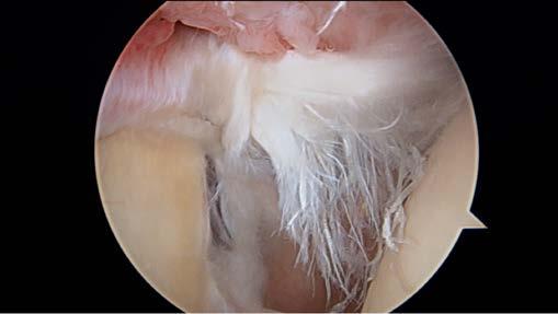 !the long head of the biceps tendon is assessed along its intra-articular portion to confirm diagnosis of partial tearing or SLAP tear at its insertion on the labrum.